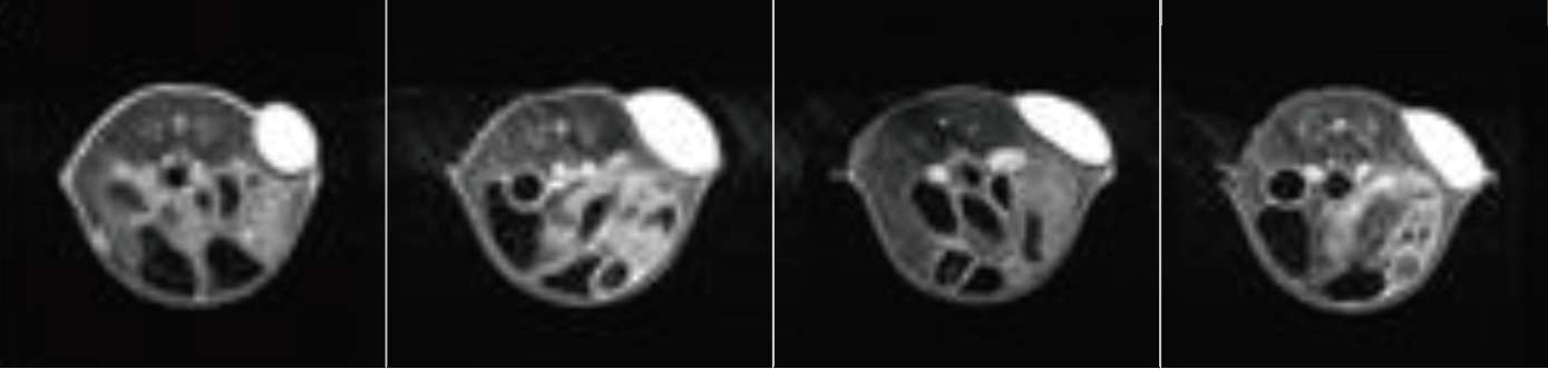 MRI: 0, 1, 2, 3 주
